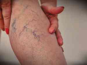 25 per cent of Indians affected by Varicose Veins, say health experts